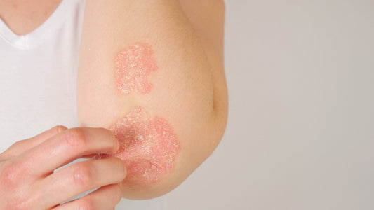 How to Heal Eczema with Neviderma Eczema Care