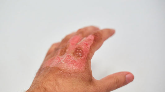 How to Heal Burn Scars with Branden Burn Lotion