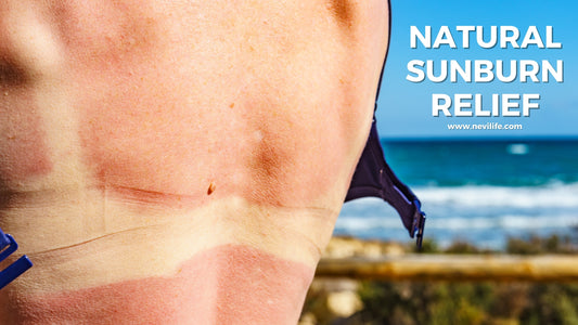 Natural Sunburn Relief with Branden Burn Lotion