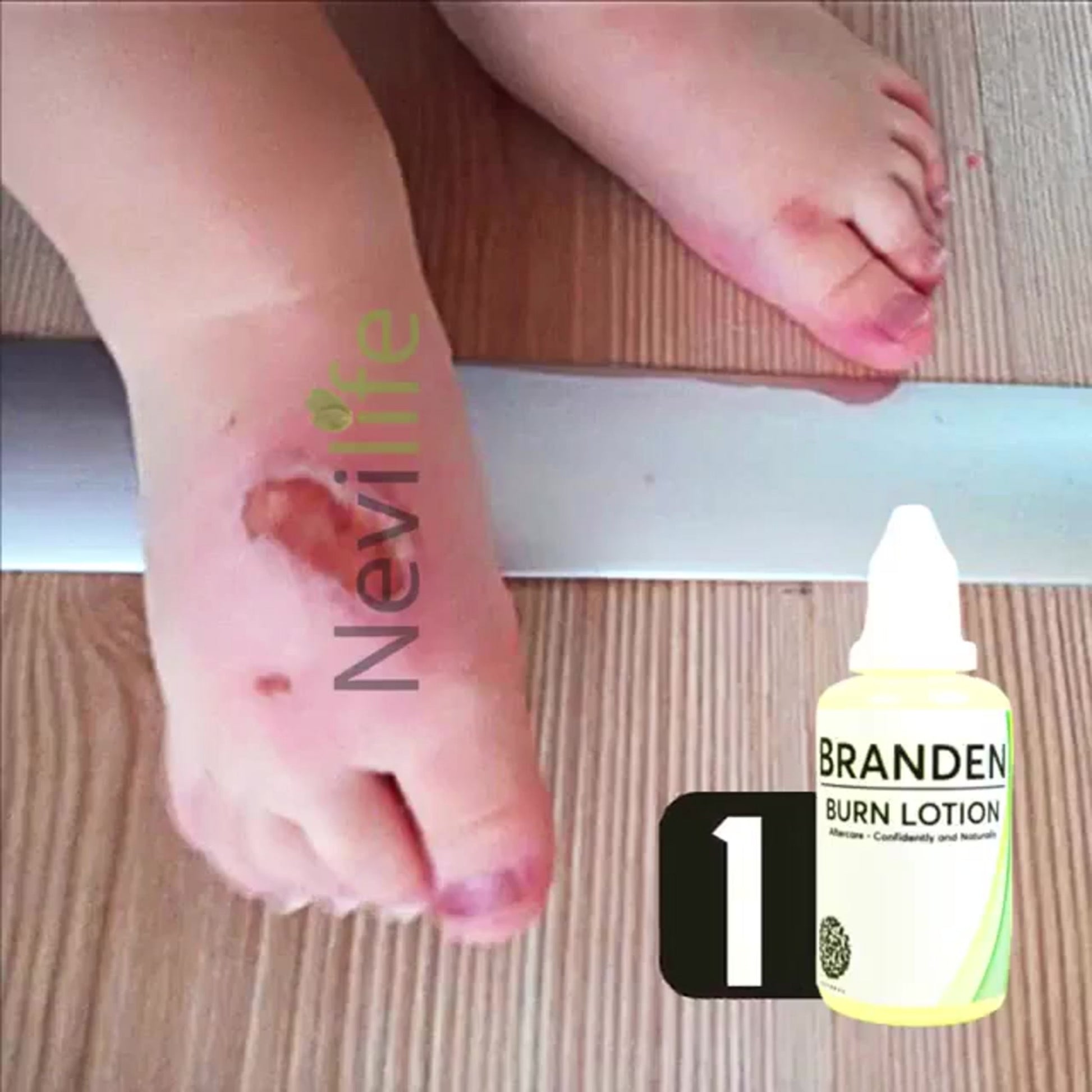 Branden Burn Lotion: Your Skin's Protector  Formulated with a unique blend of quince oil and herbal actives, Branden Burn Lotion offers rapid relief and supports the skin's natural healing process.  Quince Oil: Rich in antioxidants and vitamins, quince oil helps to nourish and protect damaged skin, accelerating the healing process. Herbal Actives: Our carefully selected blend of herbal extracts works synergistically to soothe inflammation, reduce pain, and promote skin regeneration. How It Works:  Apply Bra