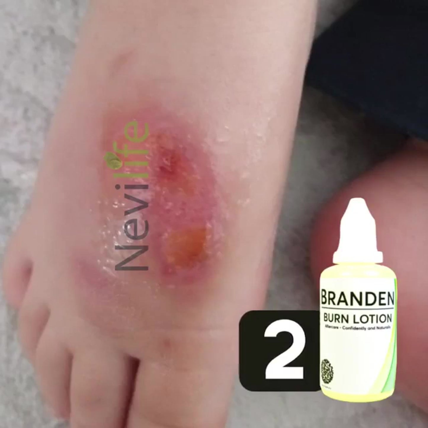 Branden Burn Lotion: Your Skin's Protector Formulated with a unique blend of quince oil and herbal actives, Branden Burn Lotion offers rapid relief and supports the skin's natural healing process. Quince Oil: Rich in antioxidants and vitamins, quince oil helps to nourish and protect damaged skin, accelerating the healing process. Herbal Actives: Our carefully selected blend of herbal extracts works synergistically to soothe inflammation, reduce pain, and promote skin regeneration. How It Works: Apply Bra