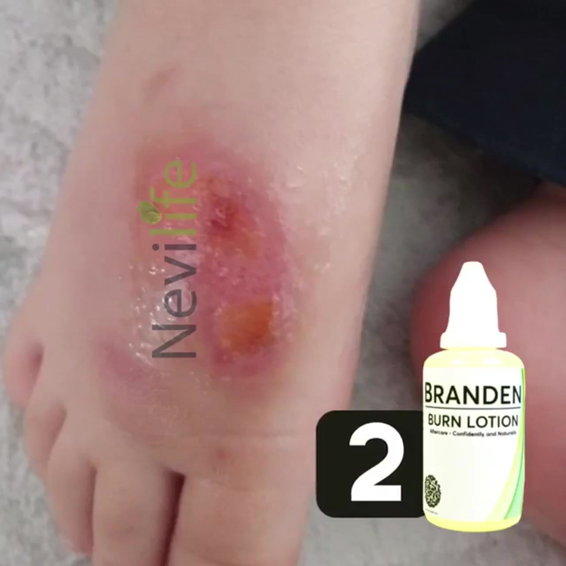 Branden Burn Lotion: Your Skin's Protector  Formulated with a unique blend of quince oil and herbal actives, Branden Burn Lotion offers rapid relief and supports the skin's natural healing process.  Quince Oil: Rich in antioxidants and vitamins, quince oil helps to nourish and protect damaged skin, accelerating the healing process. Herbal Actives: Our carefully selected blend of herbal extracts works synergistically to soothe inflammation, reduce pain, and promote skin regeneration. How It Works:  Apply Bra