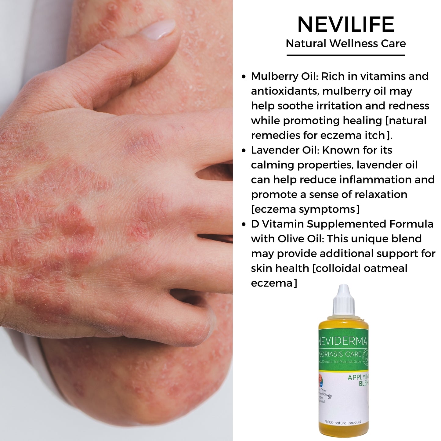 Neviderma Psoriasis Care