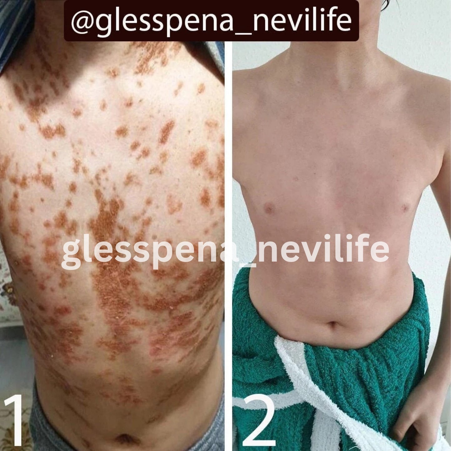 Neviderma Psoriasis Care
