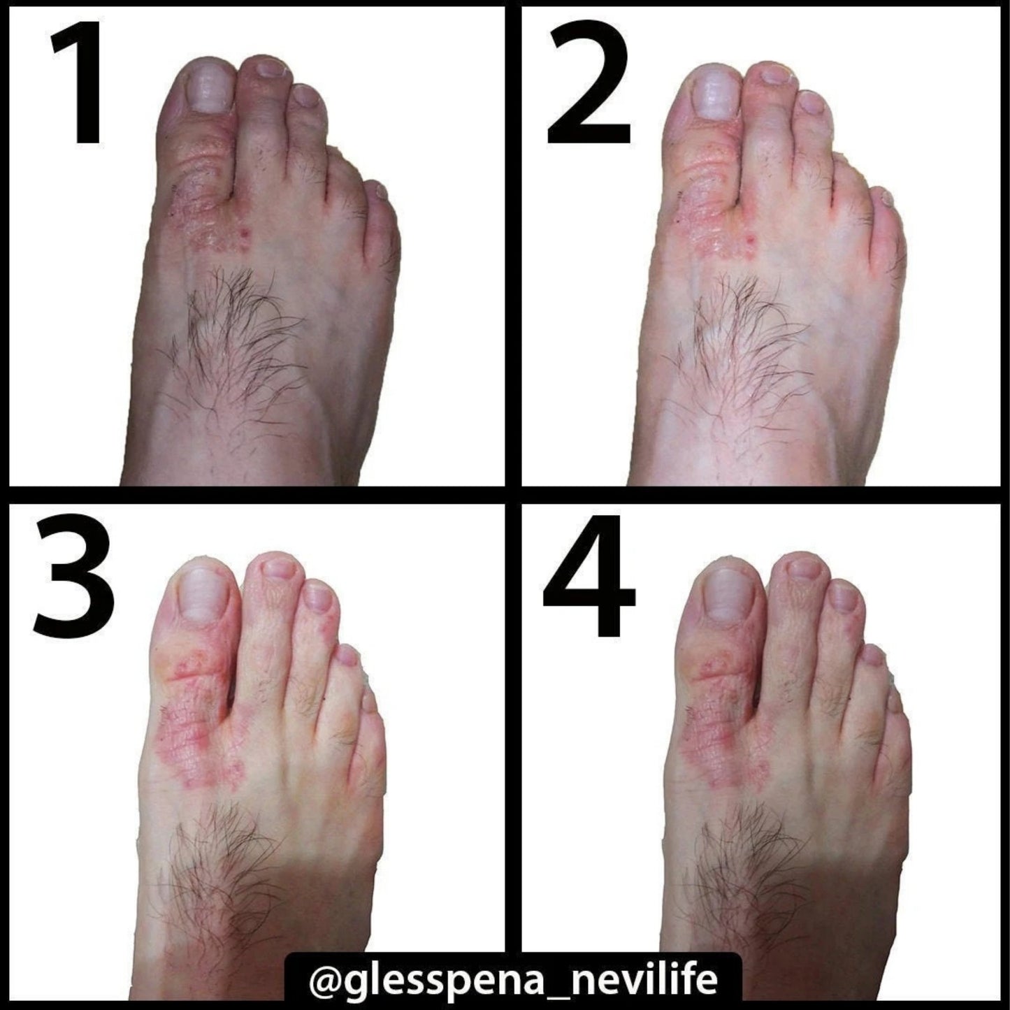Neviderma Psoriasis Care