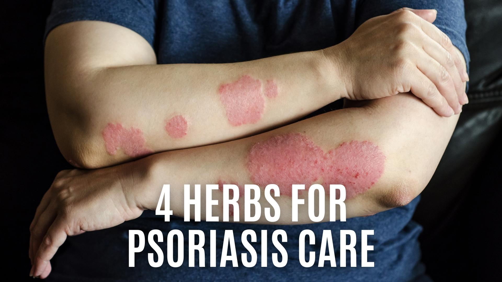 4 Herbs for Psoriasis Care – nevilife