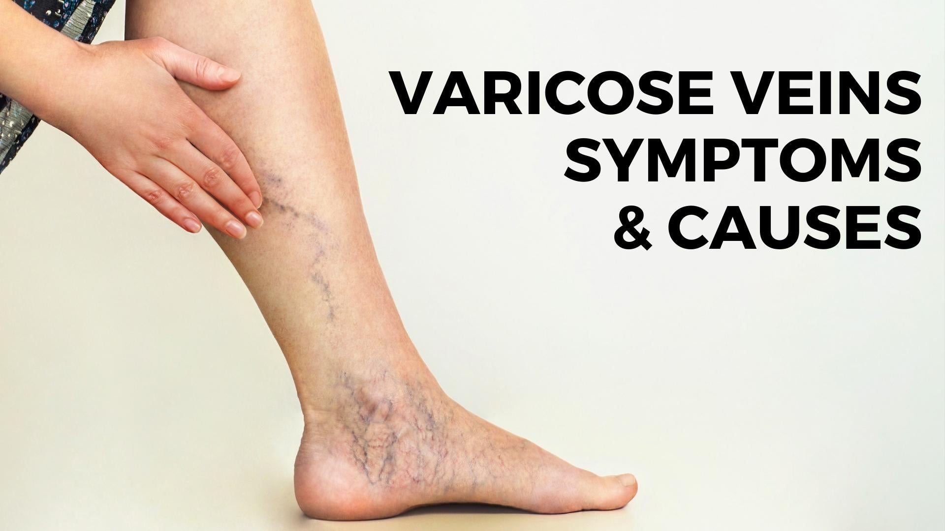 What Varicose Vein Causes? – nevilife