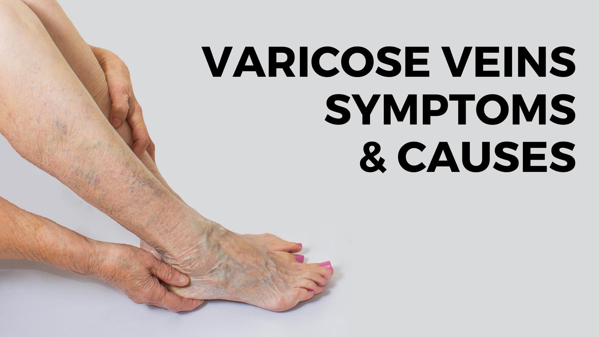 Varicose Vein Causes & Symptoms – nevilife