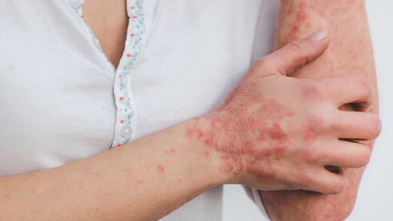How to Remove Psoriasis Scars Naturally and Nevilife Psoriasis Care Benefits