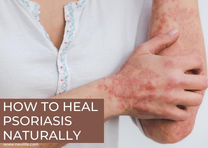 How to Heal Psoriasis Care Naturally? – nevilife