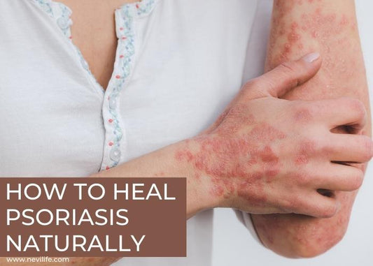 How to Heal Psoriasis Care Naturally?